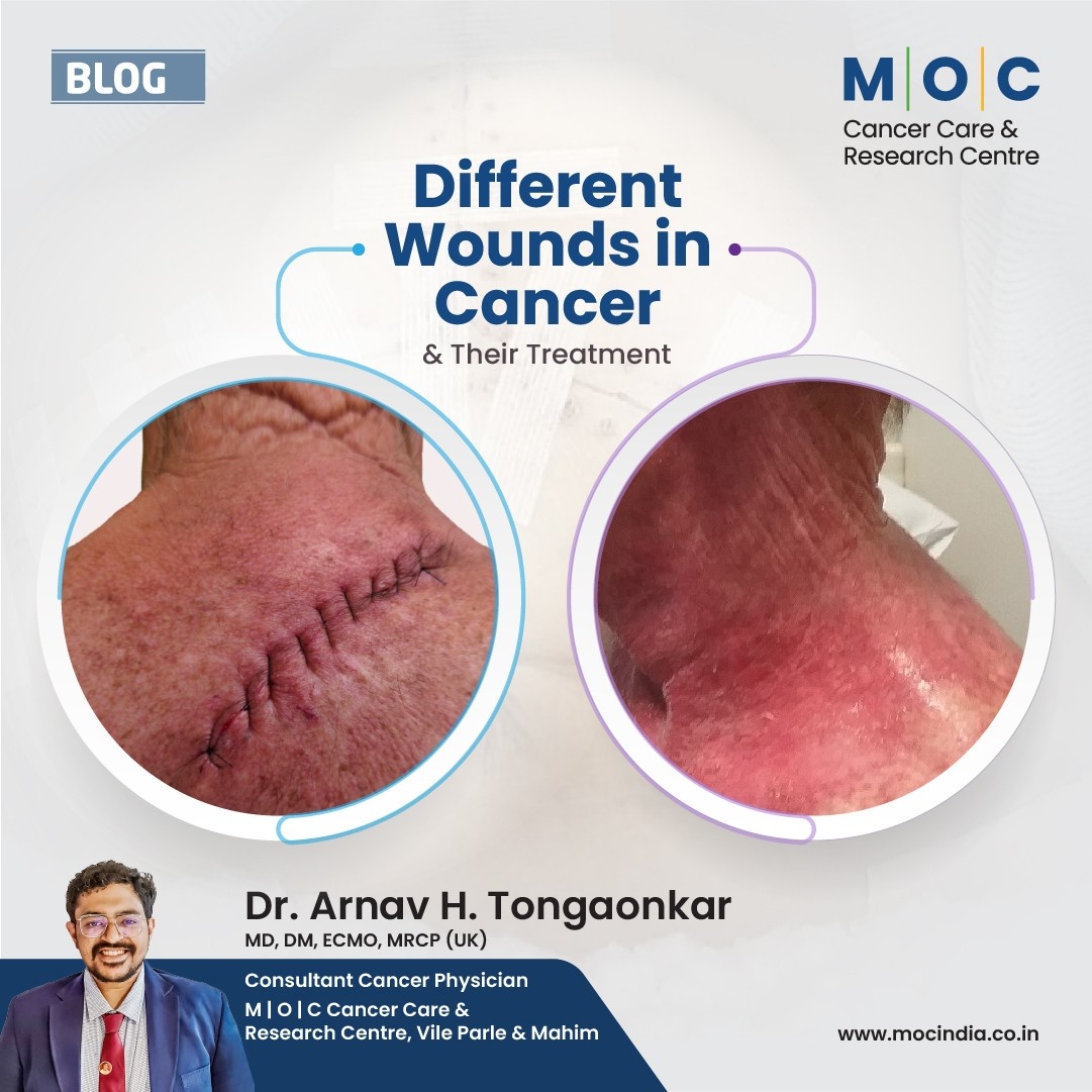 Types of Wounds During the Cancer Journey & Effective Management Tips