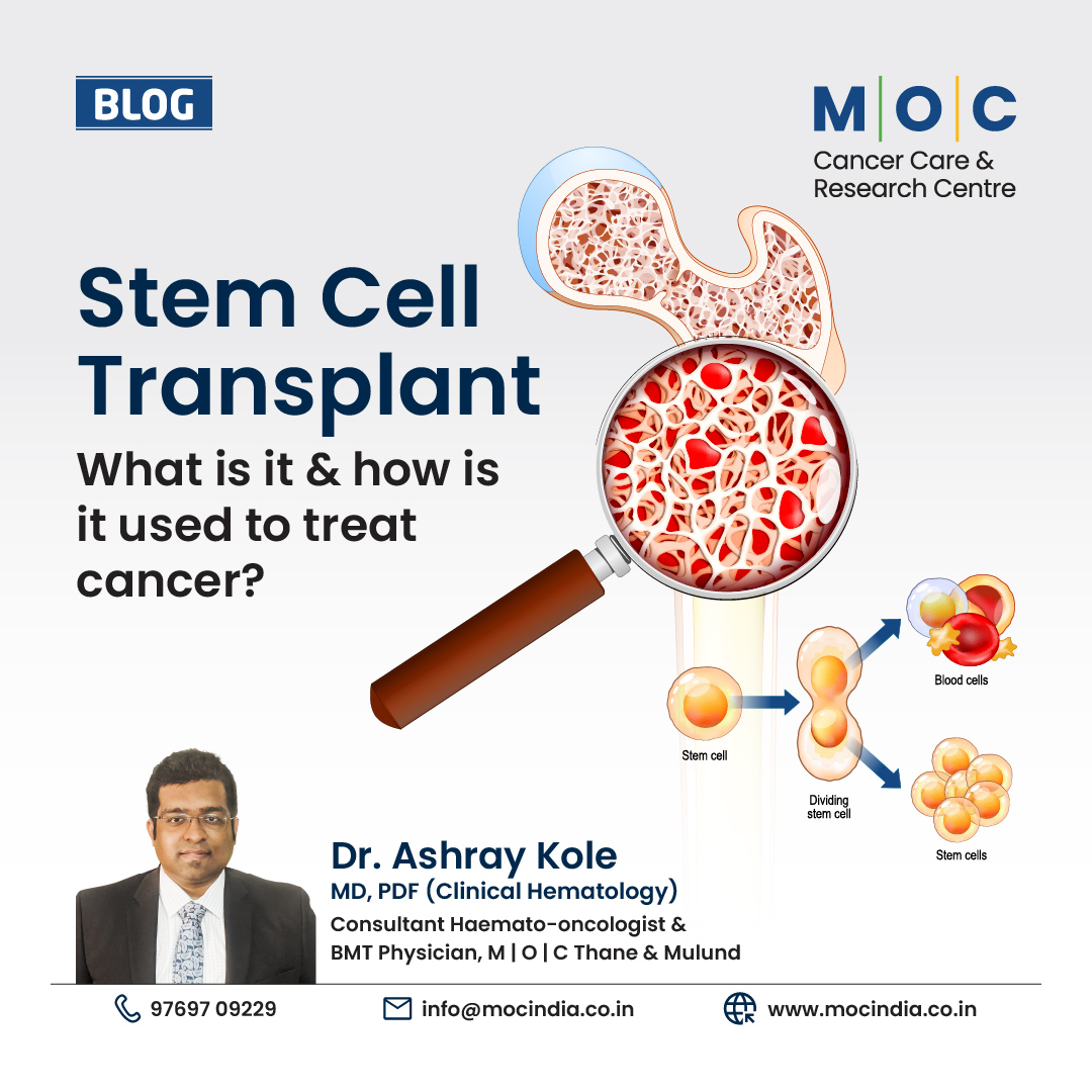 Stem Cell Transplant: What is it and how is it used to treat cancer?  